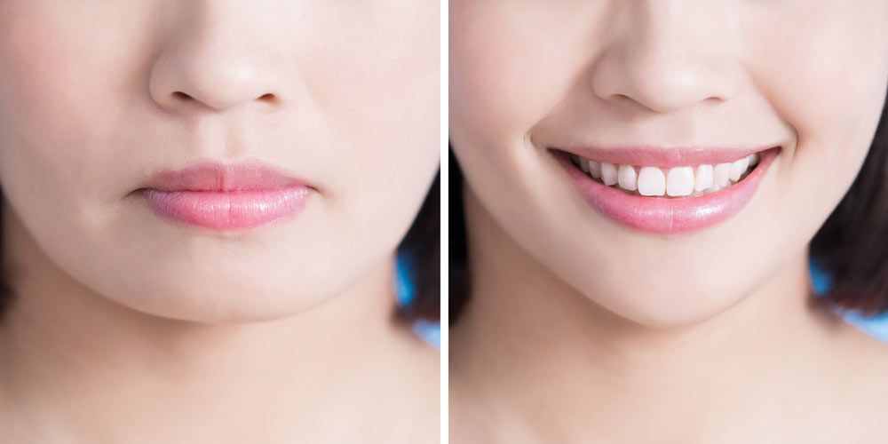 Before and after chin augmentation