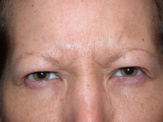 before botox