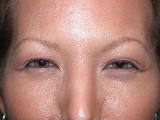 after botox