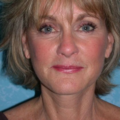 Patient after a facelift