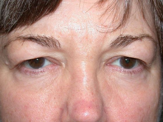 Patient ULB1201 before Eye Lift procedure