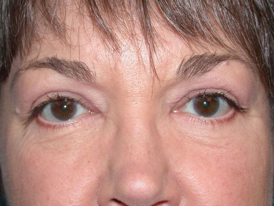 Patient ULB1201 after Eye Lift procedure