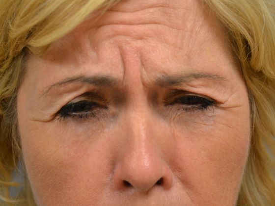 before botox