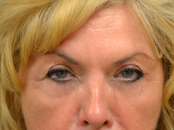 after botox