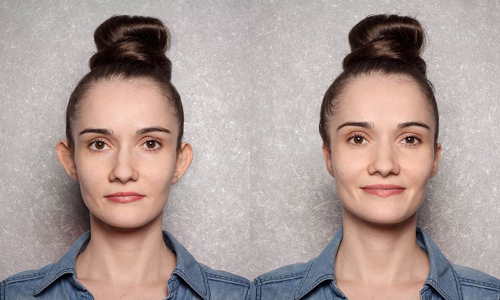 Before and after images of an otoplasty patient.